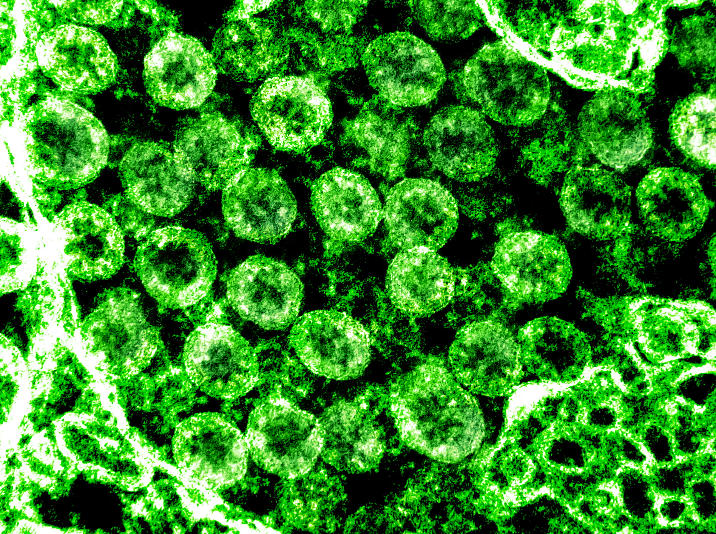 epa08262127 An undated handout picture made available by the National Institutes of Health (NIH) shows a transmission electron micrograph of SARS-CoV-2 virus particles, also known as 2019-nCoV, the virus that causes Covid-19, isolated from a patient (issued 01 March 2020). The image was captured and color-enhanced at the National Institute of Allergy and Infectious Diseases (NIAID) Integrated Research Facility (IRF) in Fort Detrick, Maryland, USA. US health officials announced on 29 February 2020 the first confirmed death from the new coronavirus in the country in Washington State. The novel coronavirus is on the verge of spreading across the world as more Covid-19 cases are emerging outside China with outbreaks in South Korea, Italy and Iran.  EPA/NIAID/NATIONAL INSTITUTES OF HEALTH HANDOUT  HANDOUT EDITORIAL USE ONLY/NO SALES
