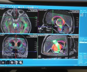 03.06.2016. Zagreb - U KBC Sestre milosrdnice, na Klinici za neurokirurgiju izvodi se operacija tumora na mozgu koja se radi novom tehnologijom, a uz tu opremu vise nece biti neoperabilnih tumora na mozgu. 
Photo: Tomislav Miletic/PIXSELL