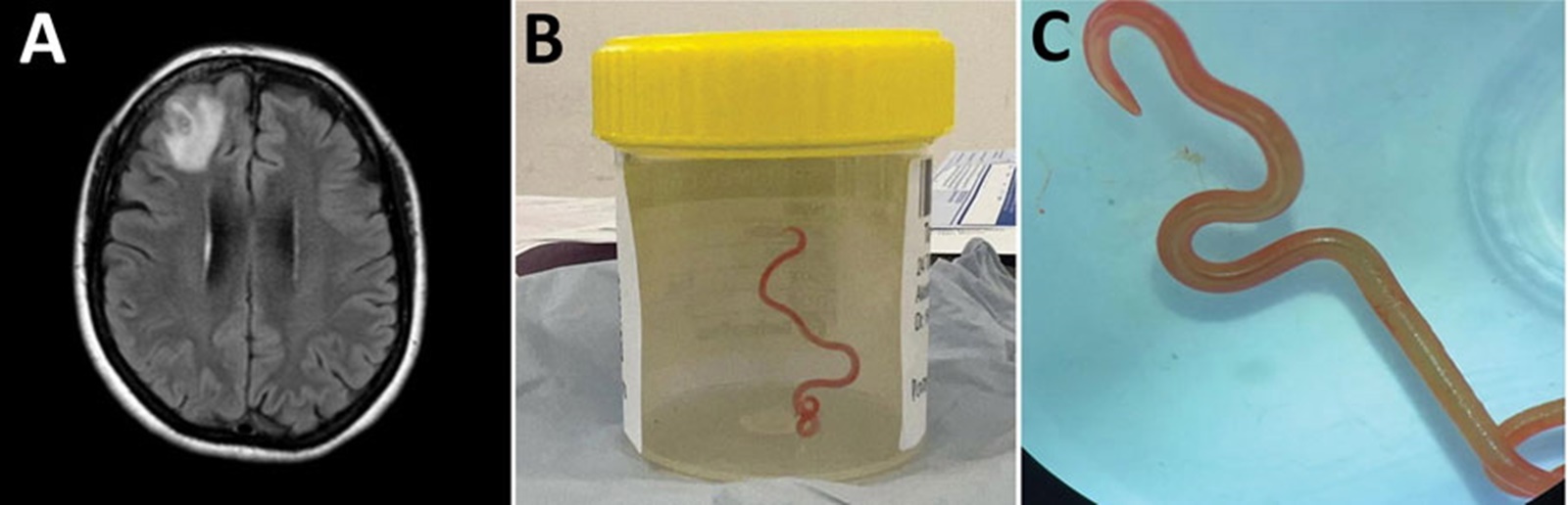 epa10826364 A undated handout photo made available by Australian National University issued on 29 August 2023 of a composite picture after a Ophidascaris robertsi roundworm was found alive in the brain of an Australian woman in 2022, Canberra, Australia. Magnetic resonance image of the patient's brain (L), a live third-stage larval form of Ophidascaris robertsi (80 mm long, 1 mm diameter) removed from the patient's right frontal lobe (C), live third-stage larval form of O. robertsi (80 mm long, 1 mm diameter) under stereomicroscope, original magnification ×10, (R).  EPA/Australian National University / HANDOUT  HANDOUT EDITORIAL USE ONLY/NO SALES