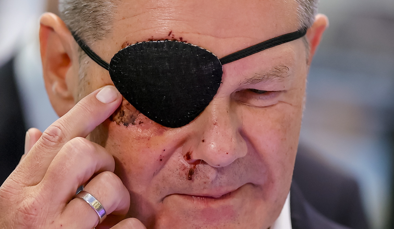 epa10841871 German Chancellor Olaf Scholz touches his bruises as he attends the opening walk at the International Motor Show (IAA) in Munich, Germany, 05 September 2023. The 2023 International Motor Show Germany IAA MOBILITY 2023 takes place in Munich from 05 to 10 September 2023. The IAA 2023 will feature numerous world premieres and has a special focus on electric mobility and digitization. Scholz is wearing an eye patch after suffering facial injuries in a sports accident.  EPA/RONALD WITTEK