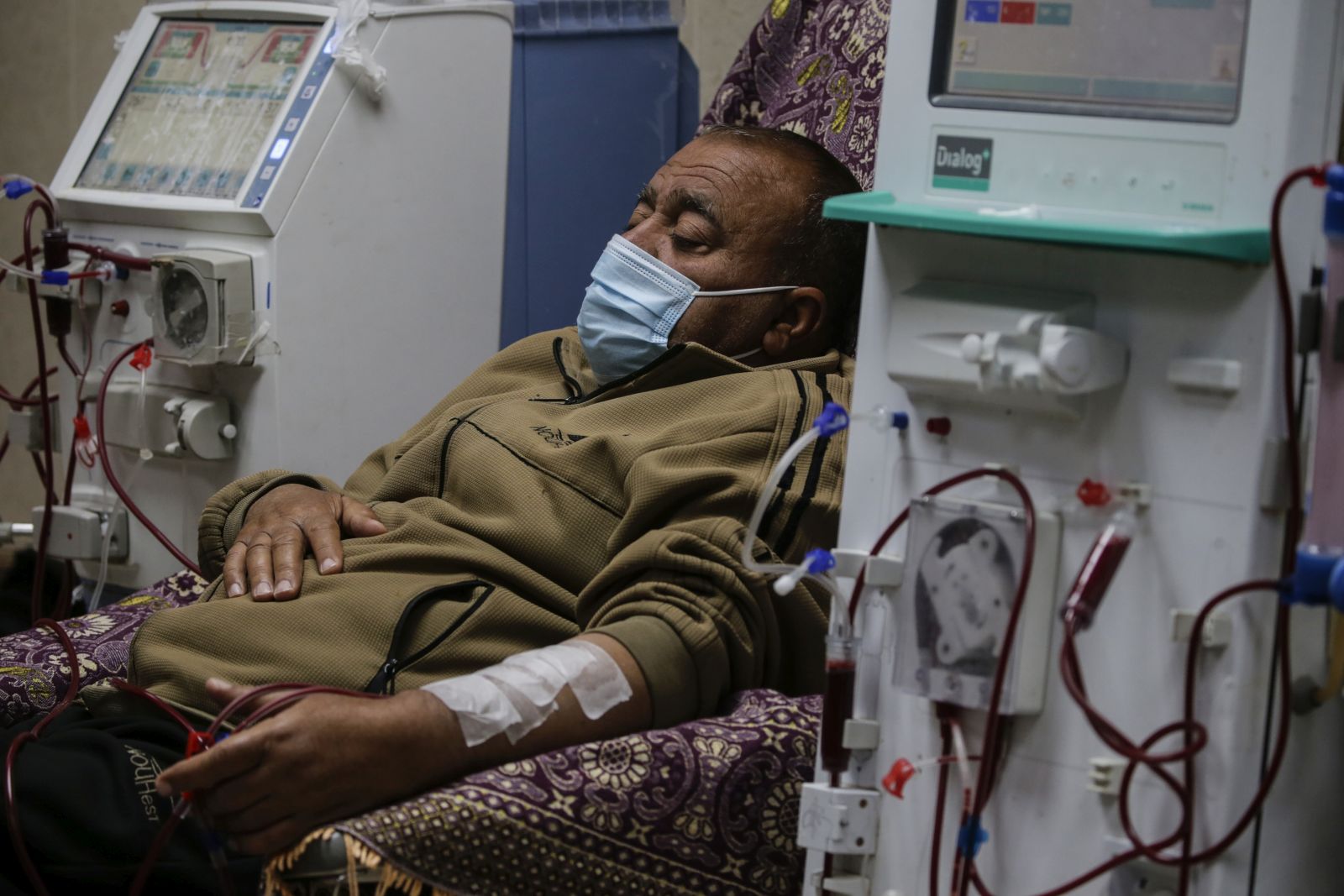 epa11225881 A patient undergoes dialysis at Al-Aqsa Hospital in Deir Al Balah, Gaza Strip, 17 March 2024. The hospital offers treatment to more than 700 internally displaced Palestinians from northern and southern Gaza suffering from kidney failure. While patients in Gaza used to receive dialysis treatment on an average of four-hour sessions three times per week, doctors at Al-Aqsa hospital confirm that patients in need of dialysis can currently only receive treatment in the form of a two-hour session once a week. More than 31,500 Palestinians and over 1,300 Israelis have been killed, according to the Palestinian Health Ministry and the Israel Defense Forces (IDF), since Hamas militants launched an attack against Israel from the Gaza Strip on 07 October 2023, and the Israeli operations in Gaza and the West Bank which followed it.  EPA/MOHAMMED SABER