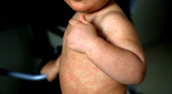 child with measles symptoms salvador, bahia / brazil - february 14, 2017: Child with measles symptoms is seen with small red spots on body and feverish state. *** Local Caption *** . SALVADOR BAHIA BRASIL Copyright: xJoaxSouzax 220117JOA05Z,Image: 803183975, License: Rights-managed, Restrictions: imago is entitled to issue a simple usage license at the time of provision. Personality and trademark rights as well as copyright laws regarding art-works shown must be observed. Commercial use at your own risk., Credit images as "Profimedia/ IMAGO", Model Release: no, Credit line: Joa Souza / imago stock&people / Profimedia