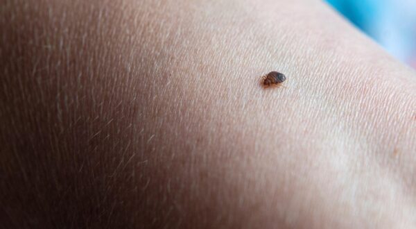 PRODUCTION - 23 June 2021, Lower Saxony, Delmenhorst: A bedbug bites an arm.  Bed bugs are not at all uncommon. The bloodsuckers are nocturnal and masters at hiding, but bed bug sniffing dogs detect the insects. Photo: Sina Schuldt/dpa /DPA/PIXSELL